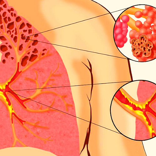 Is vaping affecting your lungs- Vaperite - Vape